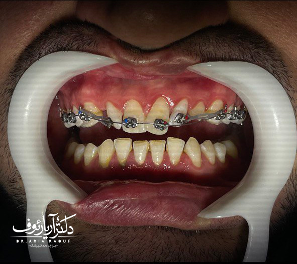 نتیجه نهایی درمان ارتودنسی بزرگسالان و دستیابی به لبخندی هماهنگ و زیبا در کلینیک دکتر رئوف.