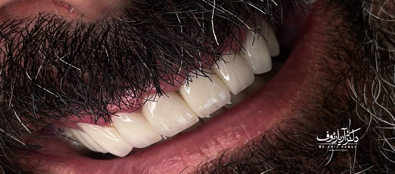 نتیجه نهایی لمینتهای سرامیکی رنگ A1 نتیجه نهایی و لبخند بینقص بیمار پس از جراحی لثه و نصب لمینتهای سرامیکی به رنگ طبیعی A1.