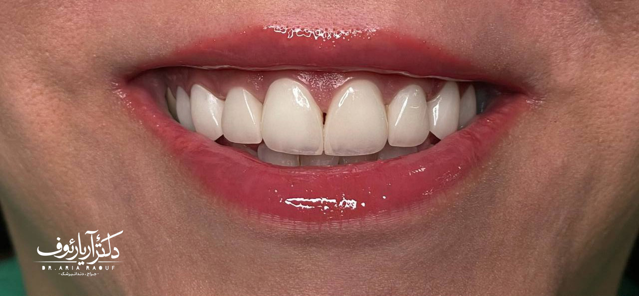 نتیجه نهایی لمینتهای سرامیکی رنگ B1 نتیجه نهایی و لبخند درخشان بیمار پس از نصب لمینتهای سرامیکی جدید به رنگ B1 در کلینیک دکتر رئوف.