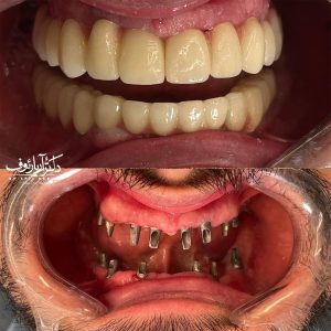 تصویر گرافیکی برای برنامهریزی هزینه و قیمت ایمپلنت دندان در تبریز در سال ۱۴۰۴.