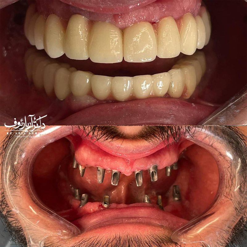 تصویر گرافیکی برای برنامه‌ریزی هزینه و قیمت ایمپلنت دندان در تبریز در سال ۱۴۰۴.