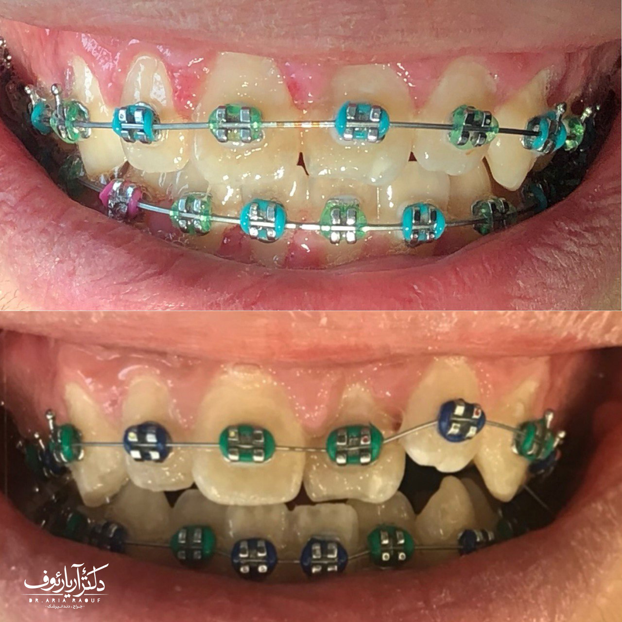 نتیجه نهایی درمان ارتودنسی ثابت برای اصلاح نامرتبی و شلوغی شدید دندان‌ها در کلینیک دکتر رئوف.