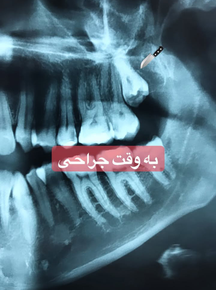 نتیجه نهایی درمان تحلیل لثه پس از جراحی موفقیتآمیز پیوند لثه در کلینیک دکتر آریا رئوف.