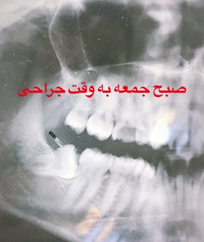 کلاژ تصویری از انواع جراحیهای لثه شامل لیفت لثه برای لبخند لثهای و پیوند لثه برای درمان تحلیل لثه.