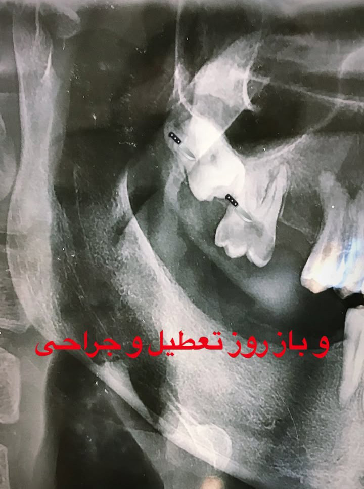 نتیجه نهایی درمان لبخند لثهای پس از جراحی لیفت لثه با لیزر در کلینیک دکتر رئوف در تبریز.