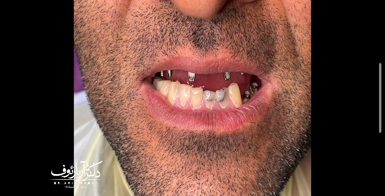 تصویر جای خالی دندان بیمار قبل از شروع درمان و کاشت ایمپلنت کره‌ای در کلینیک دندانپزشکی دکتر آریا رئوف.