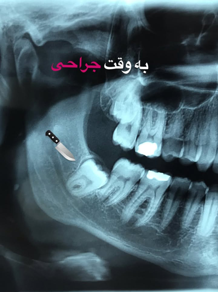 نمای لثههای سالم بیمار پس از جراحی موفقیتآمیز حذف پاکت پریودنتال برای درمان بیماری لثه.