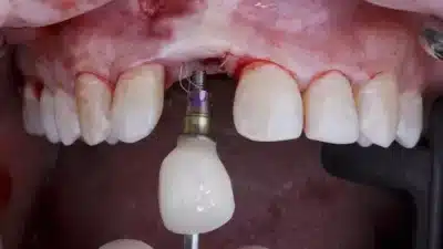 risks-cheap-dental-implant-tabriz