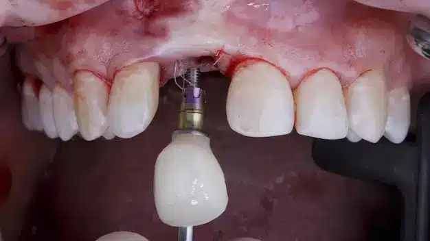 risks-cheap-dental-implant-tabriz