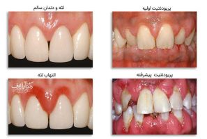 بیماری پریودنتال چیست؟