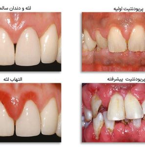 بیماری پریودنتال چیست؟