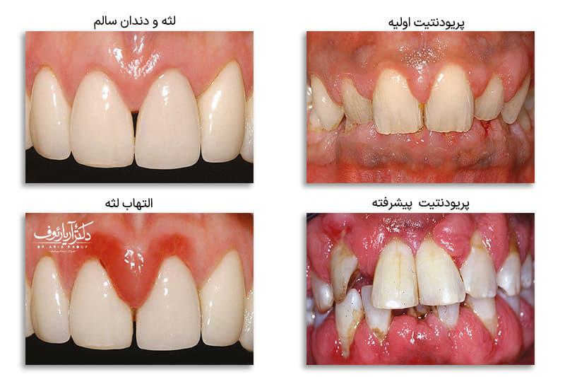 بیماری پریودنتال چیست؟