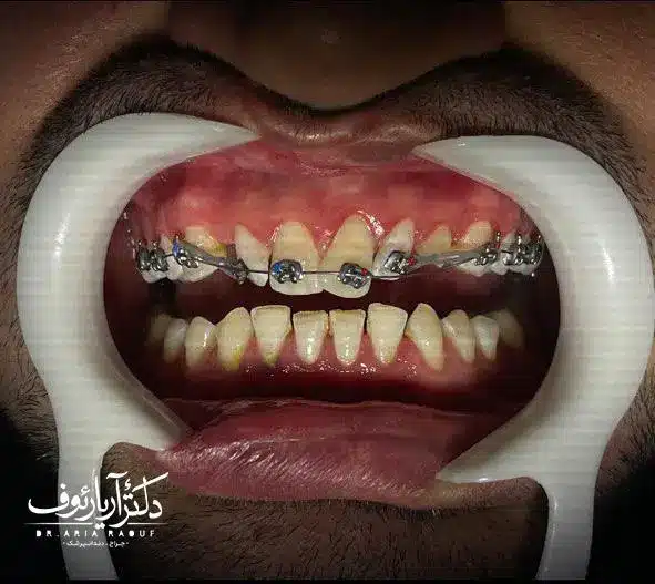 نتیجه نهایی درمان ارتودنسی بزرگسالان و دستیابی به لبخندی هماهنگ و زیبا در کلینیک دکتر رئوف.