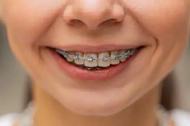 نمونه کار قبل و بعد از ارتودنسی بزرگسالان در تبریز، نمایشگر اصلاح کامل نامرتبی دندان‌ها در کلینیک دکتر رئوف.