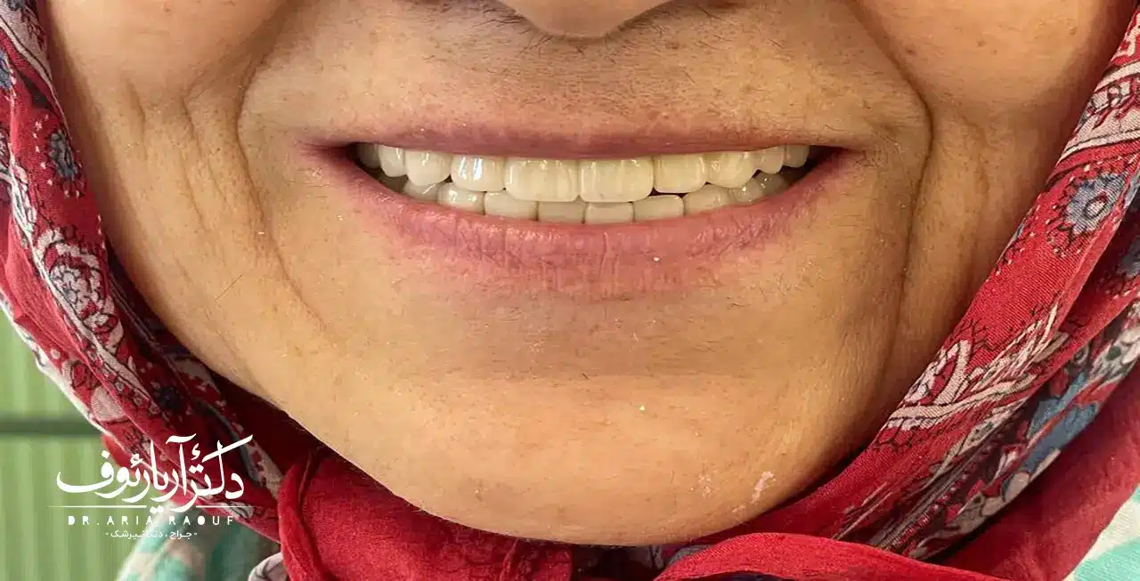 نتیجه نهایی درمان ترکیبی پس از کاشت ایمپلنت‌های کره‌ای و بازسازی تاج دندان‌ها با روکش‌های سرامیکی توسط دکتر آریا رئوف.