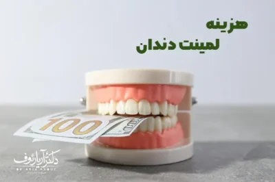 راهنمای کامل هزینه و قیمت هر واحد لمینت دندان سرامیکی در کلینیک دکتر آریا رئوف در تبریز.