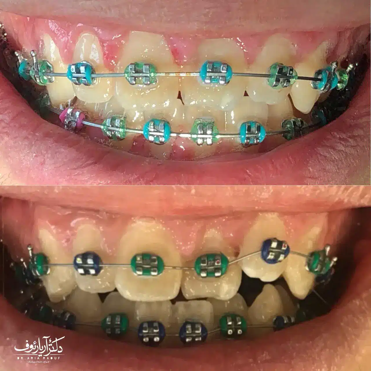 نتیجه نهایی درمان ارتودنسی ثابت برای اصلاح نامرتبی و شلوغی شدید دندان‌ها در کلینیک دکتر رئوف.