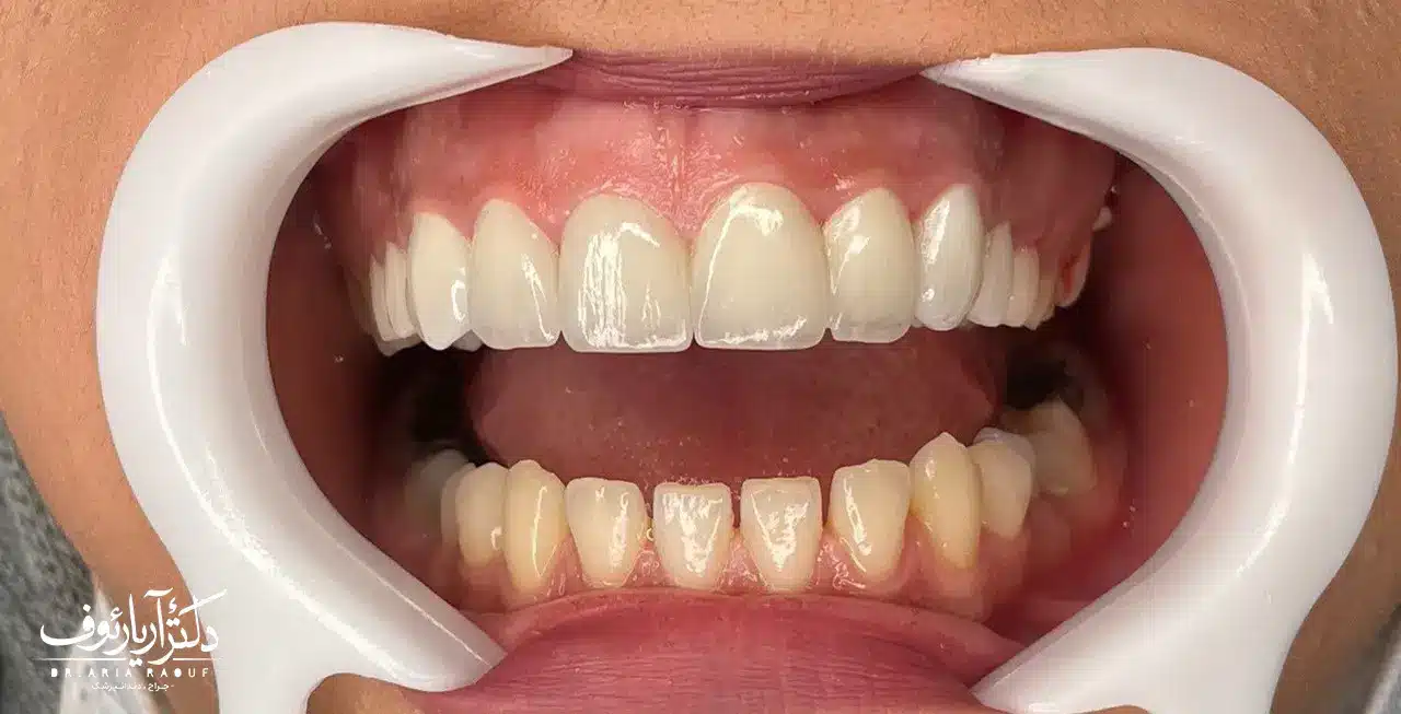 نتیجه نهایی و لبخند بی‌نقص بیمار پس از نصب لمینت‌های سرامیکی با دوام و زیبایی خیره‌کننده.