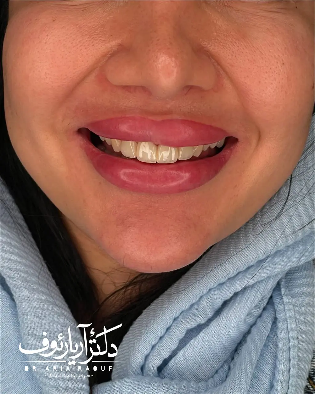 نمونه کار طراحی لبخند کامل بیمار با لمینت‌های سرامیکی در کلینیک دکتر آریا رئوف در تبریز.