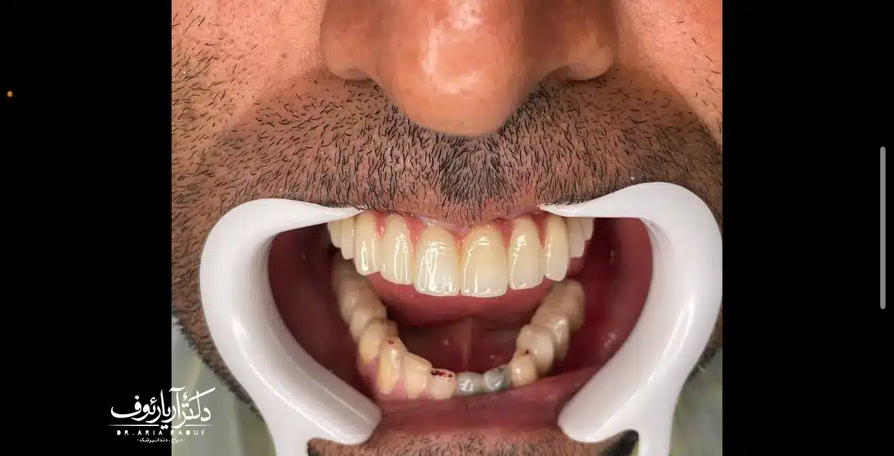 نتیجه نهایی درمان پس از کاشت موفقیت‌آمیز ایمپلنت کره‌ای و نصب روکش زیرکونیایی زیبا که با اسکن دیجیتال ساخته شده است.
