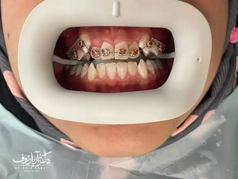 لبخند زیبا و منظم بیمار پس از اتمام درمان ارتودنسی تخصصی در کلینیک دکتر آریا رئوف در تبریز.