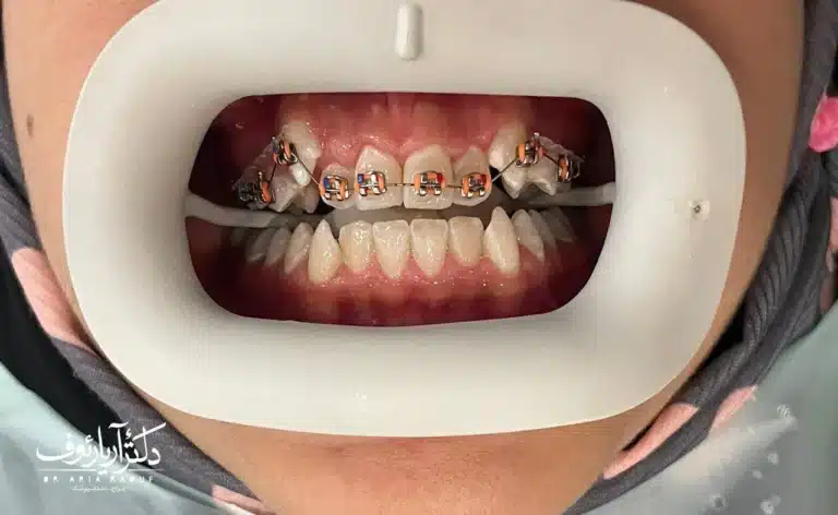 نتیجه درمان و اصلاح کامل اپن بایت پس از دوره درمانی ارتودنسی تخصصی.