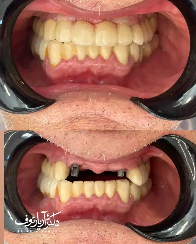 اینفوگرافیک مقایسه مزایای ایمپلنت سوئیسی در مقابل معایب و ملاحظات ایمپلنت کره‌ای