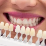 راهنمای کامل هزینه و قیمت هر واحد ونیر کامپوزیتی در کلینیک دکتر آریا رئوف در تبریز.