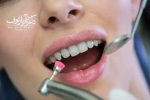 لبخند زیبا و طبیعی بیمار پس از کاشت دندان توسط بهترین دکتر ایمپلنت در تبریز، دکتر آریا رئوف