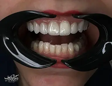 نتیجه درمان لمینت دندان در تبریز، نمایشگر لبخند زیبای بیمار پس از اصلاح فرم و رنگ دندان‌ها توسط دکتر آریا رئوف.
