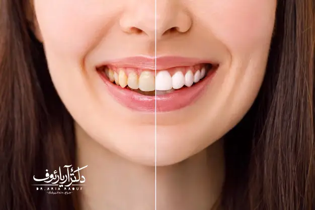 تصویری از غذاها و نوشیدنی‌های رنگی ممنوعه مانند قهوه، چای و توت‌ها که مصرف آن‌ها در ۴۸ ساعت اول پس از بلیچینگ دندان ممنوع است.