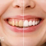 راهنمای کامل مراقبت های بعد از بلیچینگ برای افزایش ماندگاری سفیدی دندانها.