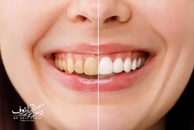 راهنمای کامل مراقبت های بعد از بلیچینگ برای افزایش ماندگاری سفیدی دندان‌ها.