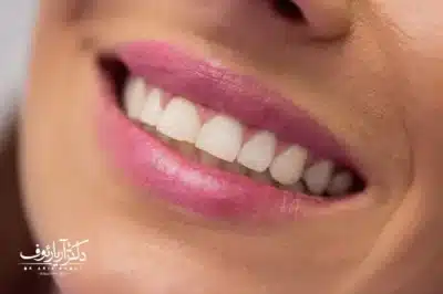راهنمای کامل هزینه و قیمت بلیچینگ (سفید کردن دندان) در کلینیک دکتر آریا رئوف در تبریز.