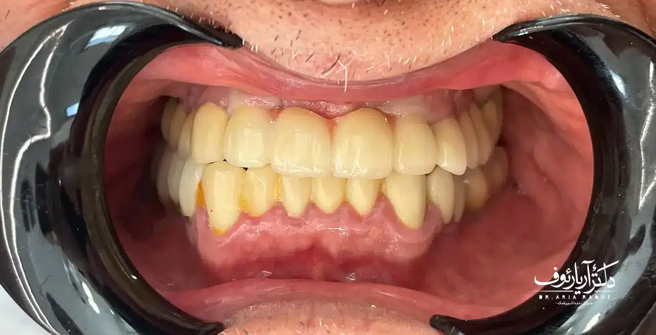 نتیجه نهایی لمینت سرامیکی و طراحی لبخند در تبریز | دکتر رئوف نتیجه نهایی و لبخند زیبای بیمار پس از لمینت دندان در تبریز توسط بهترین دکتر لمینت
