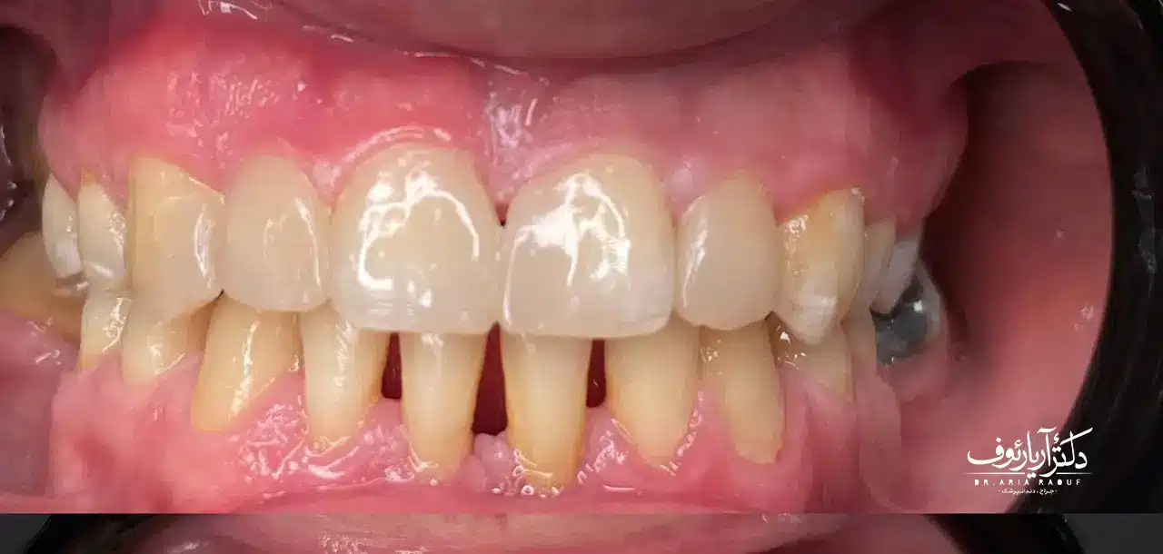 نتیجه نهایی و لبخند درخشان بیمار پس از ونیر کامپوزیت در تبریز توسط بهترین دکتر
