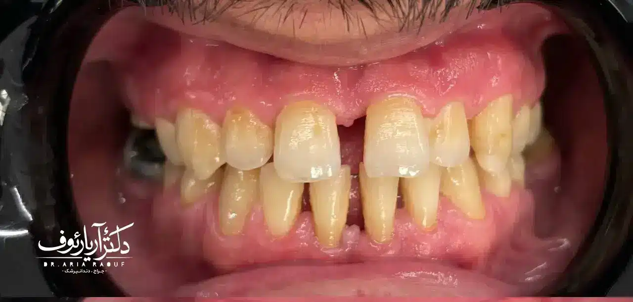 تصویر دندان‌های بیمار قبل از ونیر کامپوزیت در تبریز با لکه‌های قدیمی و فرم نامتقارن