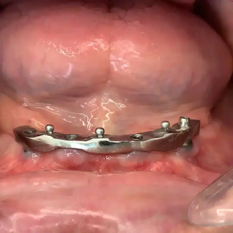 وضعیت دندان بیمار قبل از شروع درمان برای برآورد هزینه ایمپلنت دندان در تبریز
