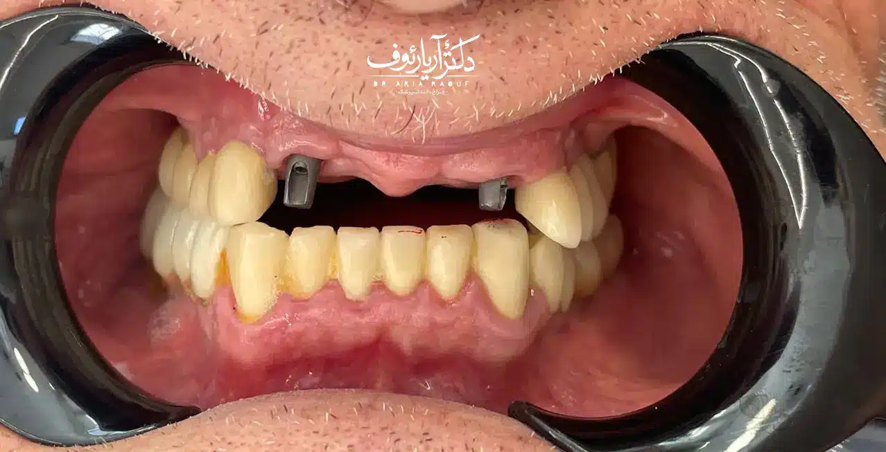 وضعیت دندانها قبل از طراحی لبخند با لمینت سرامیکی در تبریز تصویر دندانهای بیمار قبل از لمینت دندان در تبریز با مشکل فاصله و رنگ کدر