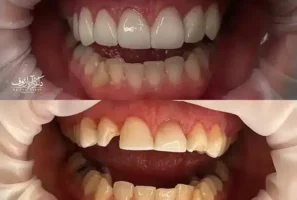 تصویر قبل و بعد از پولیش و ترمیم حرفه‌ای کامپوزیت دندان در تبریز در کلینیک دکتر رئوف