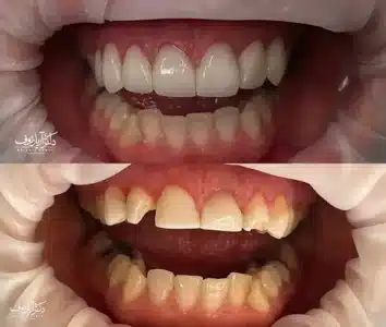 تصویر قبل و بعد از پولیش و ترمیم حرفه‌ای کامپوزیت دندان در تبریز در کلینیک دکتر رئوف