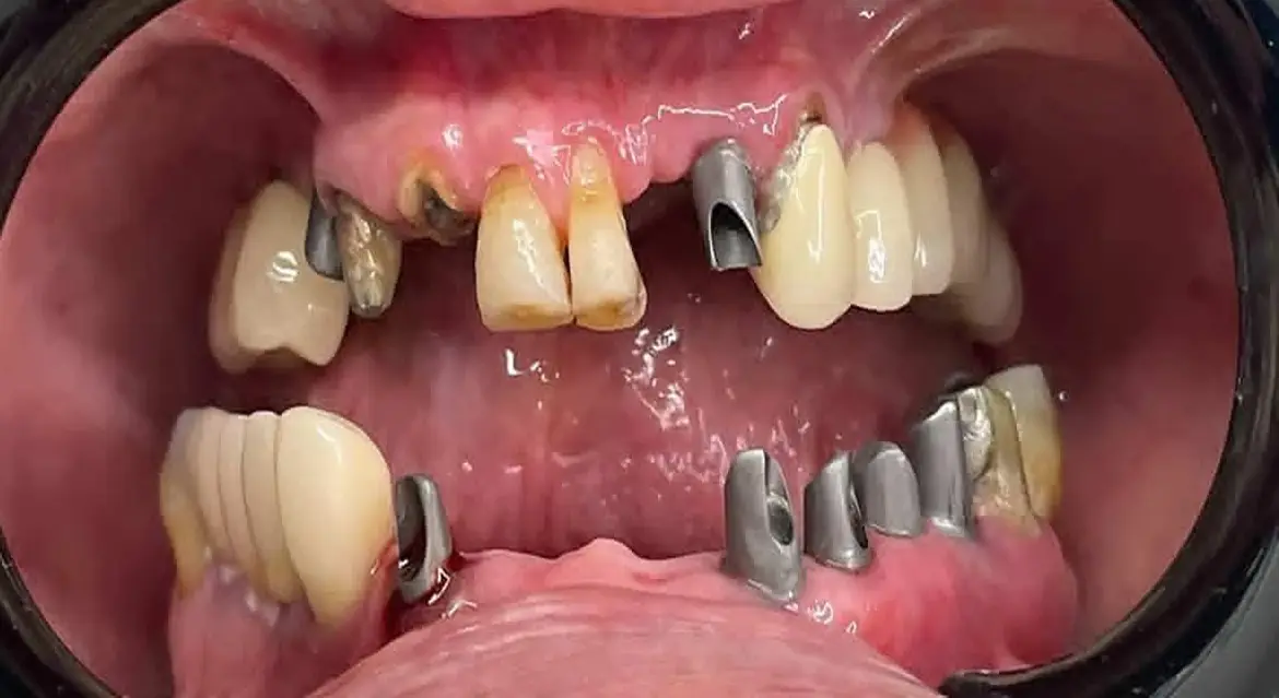 طراحی سه بعدی ایمپلنت دیجیتال در تبریز توسط متخصص ایمپلنت