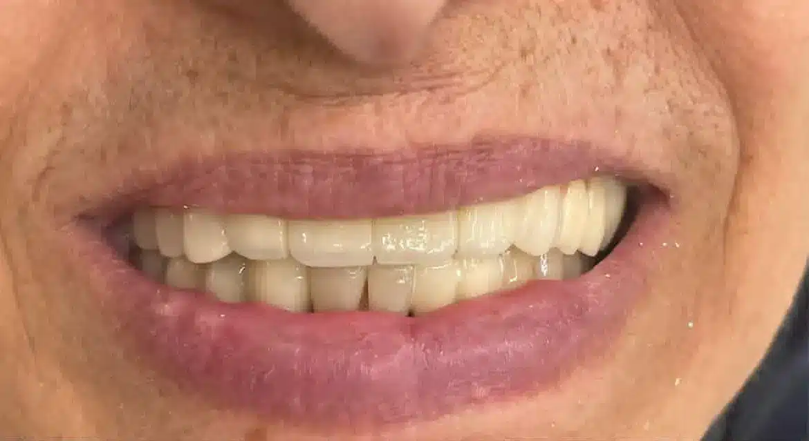 بیمار آرام در حین مشاوره برای کاشت دندان در تبریز نزد بهترین دندانپزشک