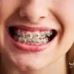 راهنمای کامل هزینه ارتودنسی دندان در تبریز و شرایط پرداخت اقساطی