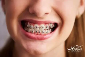 راهنمای کامل هزینه ارتودنسی دندان در تبریز و شرایط پرداخت اقساطی