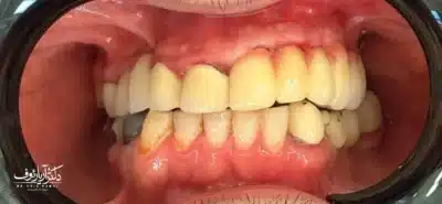 نتیجه نهایی کاشت ایمپلنت پس از پیوند استخوان توسط جراح ایمپلنت در تبریز