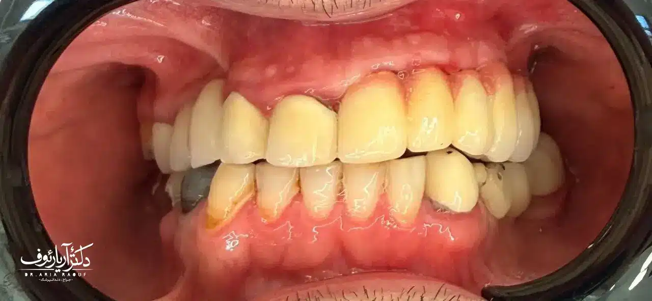 درمان موفق ایمپلنت پس از بازسازی استخوان | دکتر رئوف نتیجه نهایی کاشت ایمپلنت پس از پیوند استخوان توسط جراح ایمپلنت در تبریز