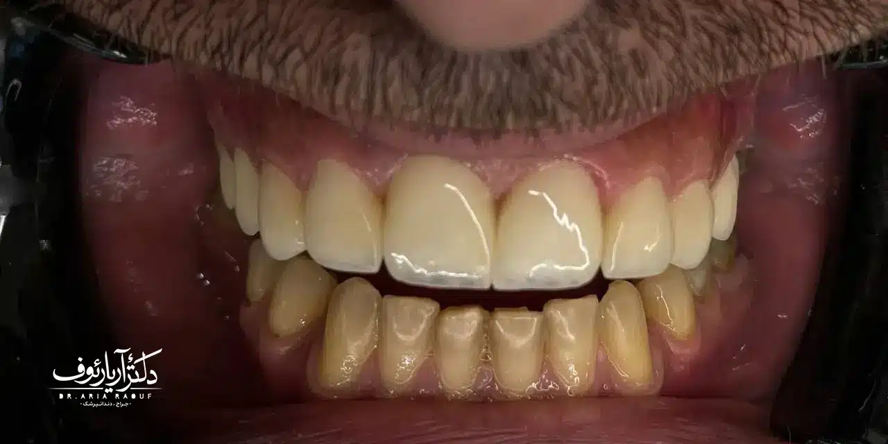 نتیجه نهایی و لبخند هالیوودی بیمار پس از درمان لمینت سرامیکی در تبریز