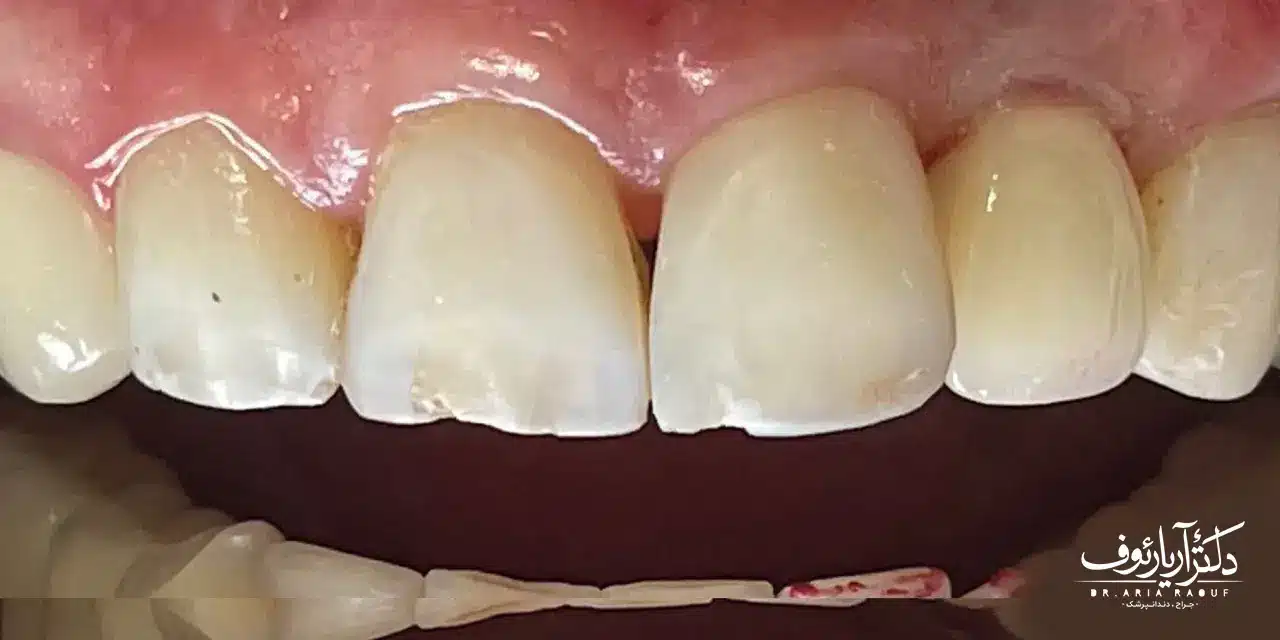 جراحی ایمپلنت دیجیتال موفق در تبریز | دکتر رئوف نتیجه دقیق و موفق کاشت دندان در تبریز با روش ایمپلنت دیجیتال توسط متخصص