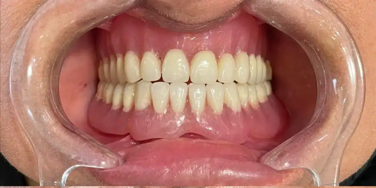 نتیجه نهایی و لبخند زیبای بیمار پس از ساخت دندان مصنوعی در تبریز توسط دکتر رئوف